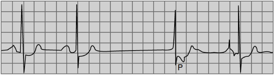 ECG 8 2 4 paro o pausa sinusal, termina con escape nodal con retroconducción del impulso a la aurícula por la presencia de onda P después de la R de el escape