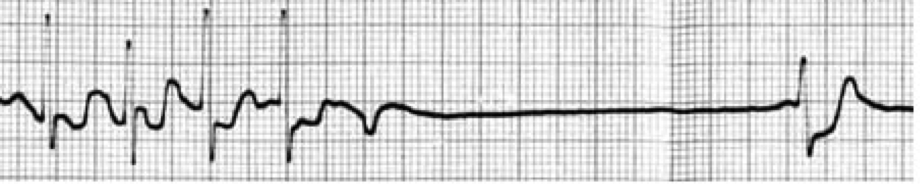ECG 8 2 7 Taquicardia sinusal , asistolia y escape nodal por cardiopatía isquémica (lesión subendocárdica )