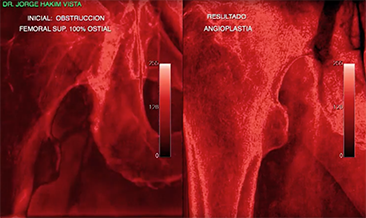 Angioplastia