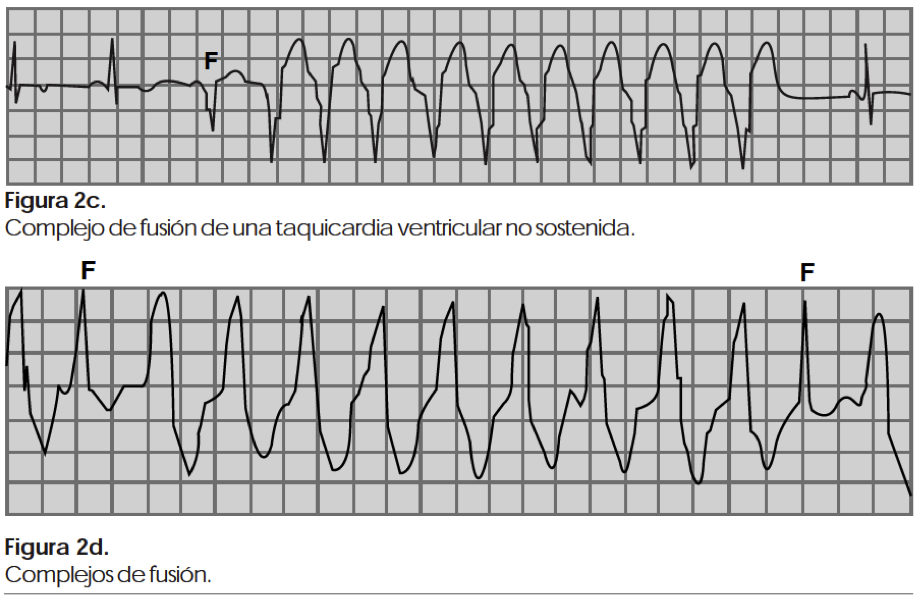 Arsenal musicas Ensangrentado ECG 7.8 Arritmias ventriculares - Cardio Science