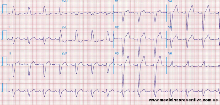 ECG 6.12 Asociado principalmente a bloqueos de rama y